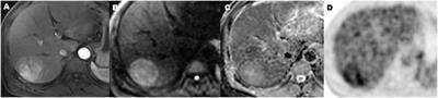 Role of preoperative prediction of microvascular invasion in hepatocellular carcinoma based on the texture of FDG PET image: A comparison of quantitative metabolic parameters and MRI